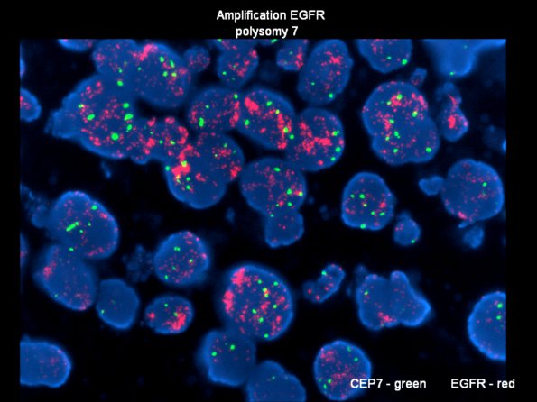 9B2 GBM (Case 9B2) FISH EGFR amplification - Copy