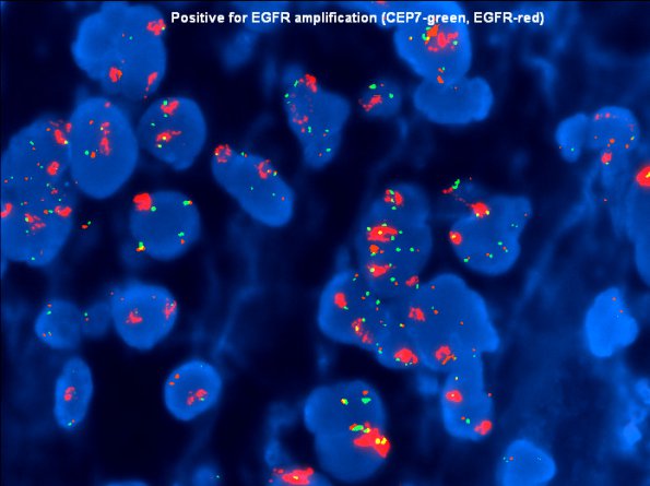 9B3 GBM (Case 9B3) EGFR-C7 - Copy