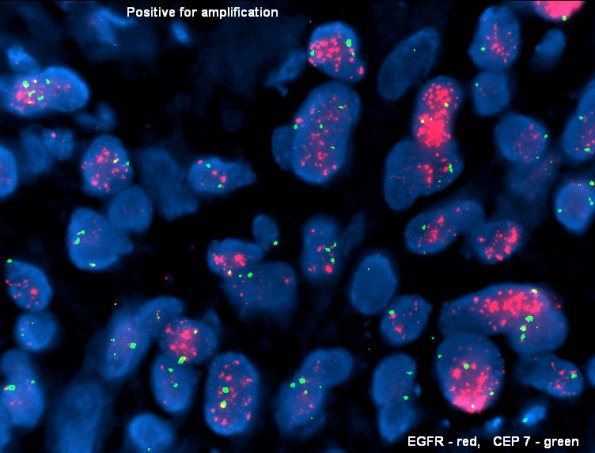 9B4 GBM (Case 9B4) EGFR-C7 - Copy