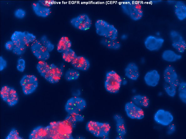 9B5 GBM (Case 9B5) amplification EGFR - Copy