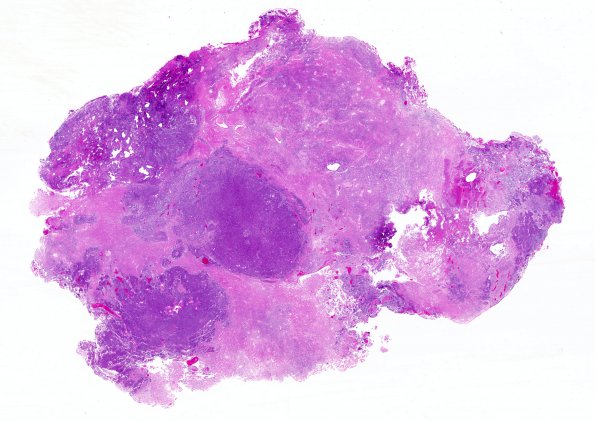 13A1 GBM, PNET Areas (Case 13) 1 H&E WM