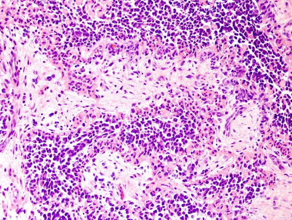 14A2 GBM, sarcomatoid and epithelioid (Case 14) H&E 10.jpg