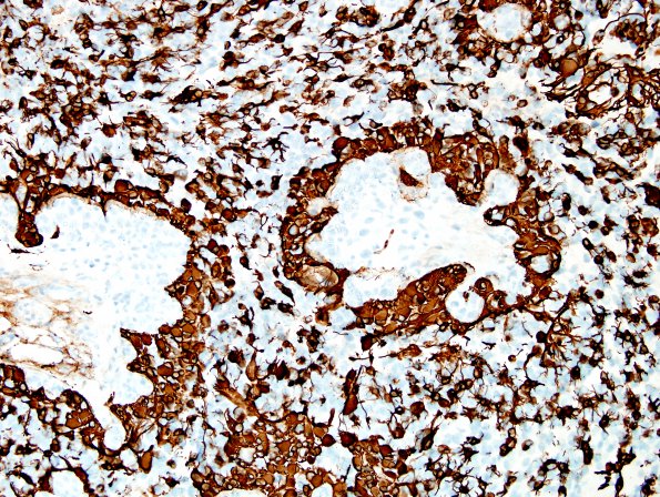 14B2 GBM, sarcomatoid and epithelioid (Case 14) GFAP 2.jpg