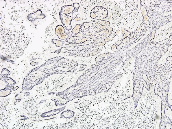 14B3 GBM, sarcomatoid and epithelioid (Case 14) Retic 2.jpg