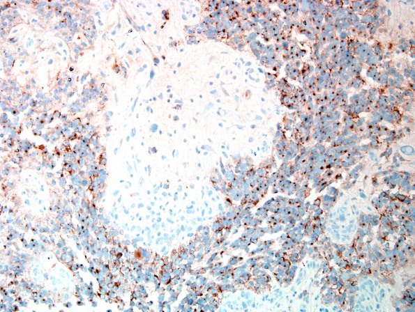 14C1 GBM, PNET & epithelioid (Case 14) B4 SYN area A 40X 2.jpg