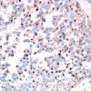 14C2 GBM, sarcomatoid and epithelioid (Case 14) SYN 1.jpg