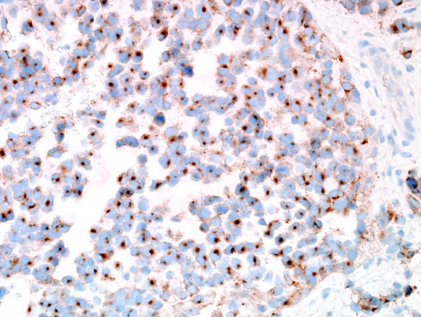 14C2 GBM, sarcomatoid and epithelioid (Case 14) SYN 1.jpg