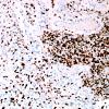 14D2 GBM, PNET & epithelioid (Case 14) B4 p53 4.jpg