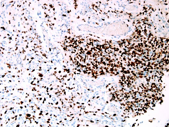 14D2 GBM, PNET & epithelioid (Case 14) B4 p53 4.jpg