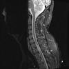 15A1 Metastasis, GBM with PNET features (Case 15) T1 - Copy