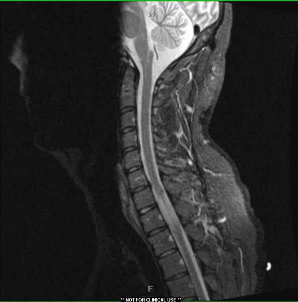 15A1 Metastasis, GBM with PNET features (Case 15) T1 - Copy