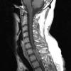 15A2 Metastasis, GBM with PNET features (Case 15) T1W 3 - Copy