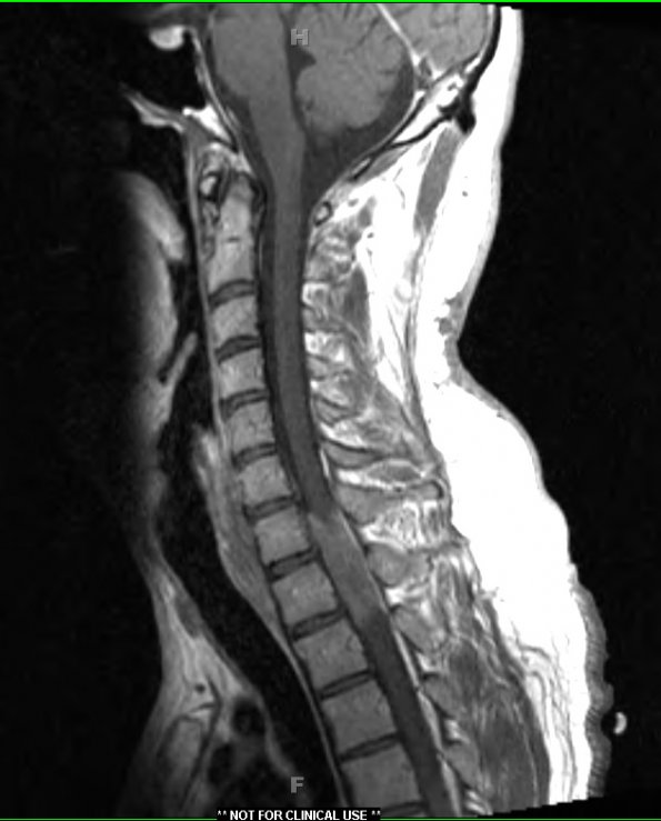 15A2 Metastasis, GBM with PNET features (Case 15) T1W 3 - Copy