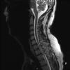 15A3 Metastasis, GBM with PNET features (Case 15) T2 - Copy