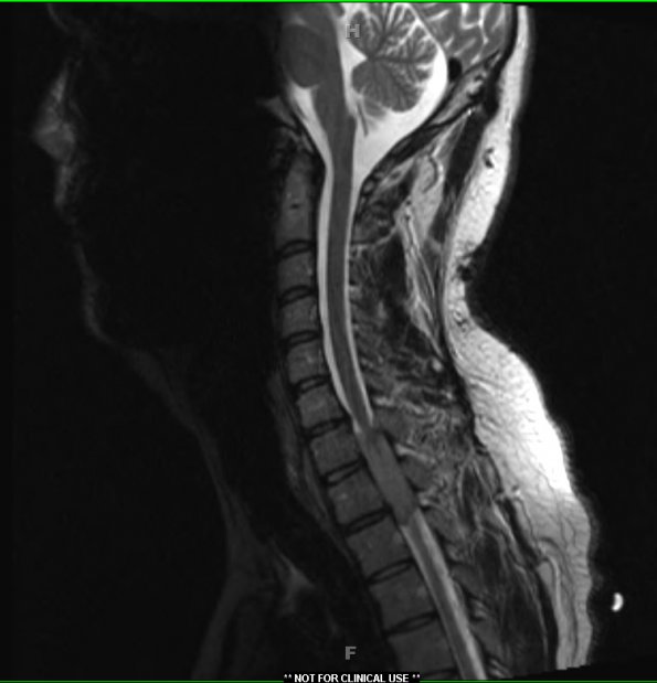 15A3 Metastasis, GBM with PNET features (Case 15) T2 - Copy