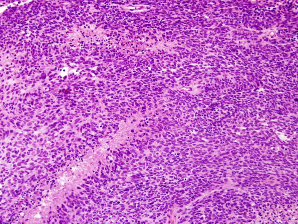 15B1 Metastasis, drop met GBM with PNET (Case 15) C7 H&E 1.jpg