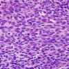 15B2 Metastasis, drop met GBM with PNET (Case 15) C7 H&E 3.jpg