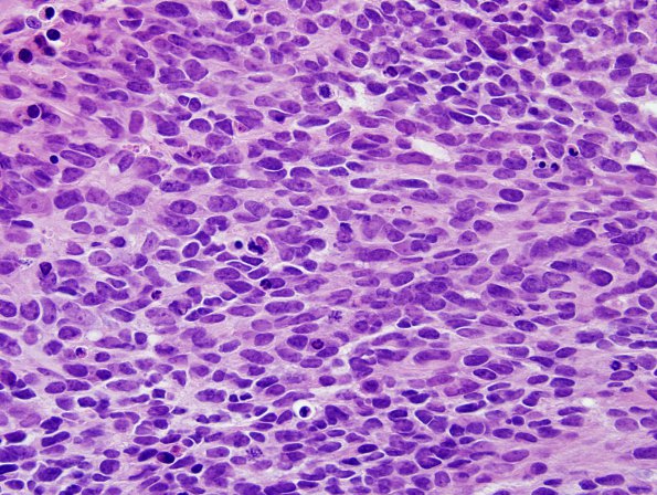 15B2 Metastasis, drop met GBM with PNET (Case 15) C7 H&E 3.jpg