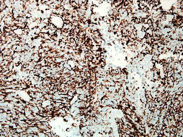 15C1 Metastasis, drop met GBM with PNET (Case 15) C7 GFAP.jpg