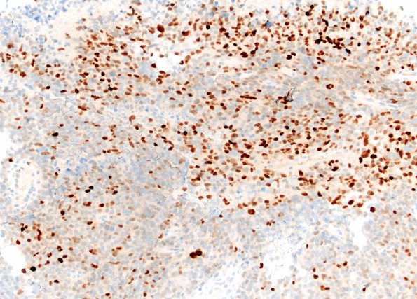 15C2 Metastasis, drop met GBM with PNET (Case 15) C7 p53 20X