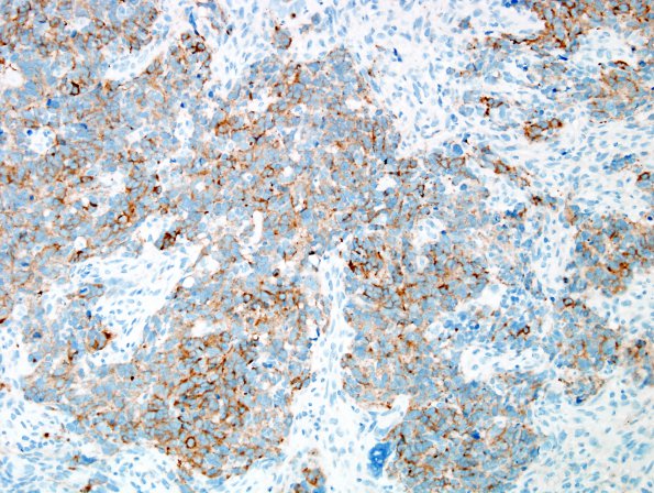 17C3 GBM vs PNET (Case 17) Area A SYN 2