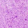 19A3 GBM with PNET and Giant Cell (Case 19) GBM area H&E 4.jpg