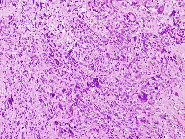 19A3 GBM with PNET and Giant Cell (Case 19) GBM area H&E 4.jpg