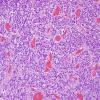 19A4 GBM with PNET and Giant Cell (Case 19) PNET area H&E 2.jpg