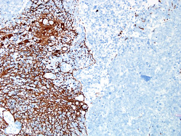 19B4 GBM with PNET and Giant Cell (Case 19) PNET area GFAP 2.jpg