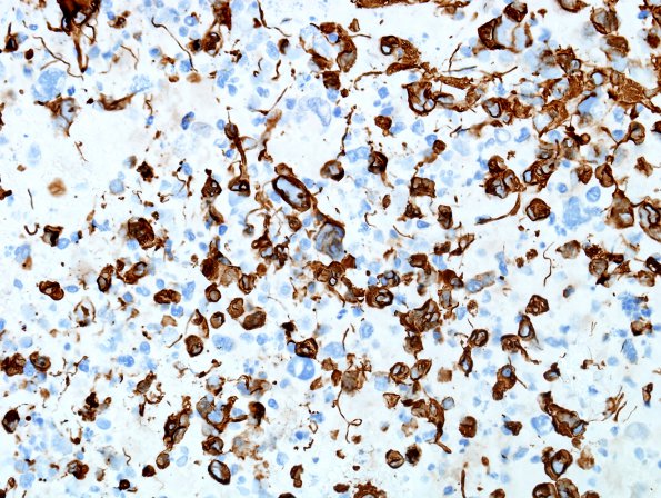 19B5 GBM with PNET and Giant Cell (Case 19) GBM area GFAP 1.jpg