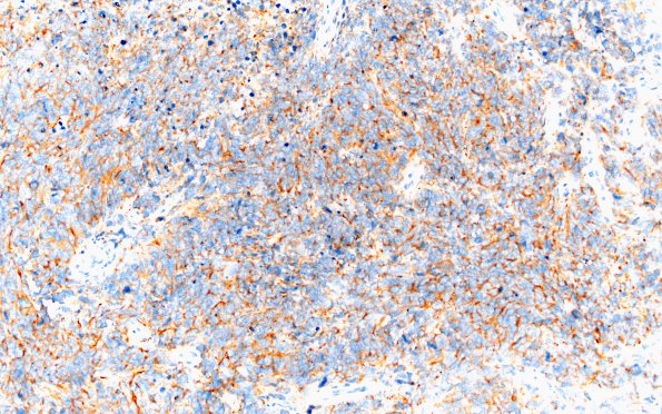 19C3 GBM with PNET and Giant Cell (Case 19) 1 SYN 20x