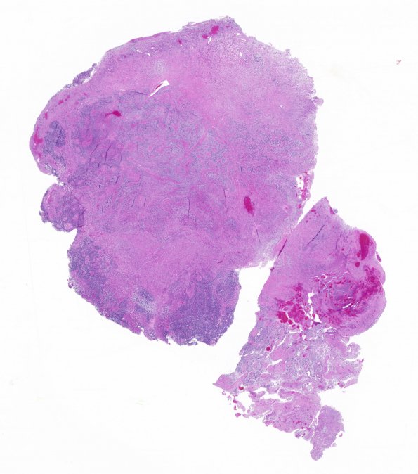 21A1 Gliosarcoma-PNET-Adenoid var (Case 21) H&E whole mount