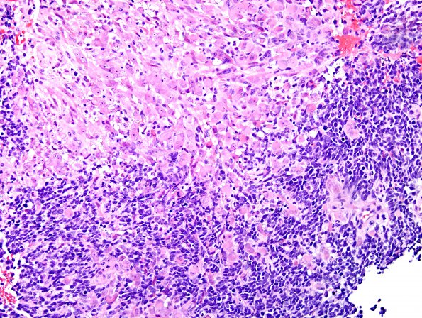 21A2 Gliosarcoma-PNET-Adenoid var (Case 21)  H&E 9