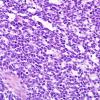 21A3 Gliosarcoma-PNET-Adenoid var (Case 21)  H&E 18