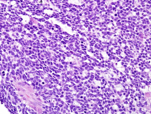 21A3 Gliosarcoma-PNET-Adenoid var (Case 21)  H&E 18