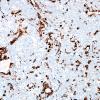 21B3 Gliosarcoma-PNET-Adenoid var (Case 21) GFAP label A