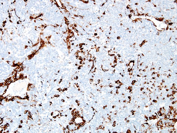 21B3 Gliosarcoma-PNET-Adenoid var (Case 21) GFAP label A