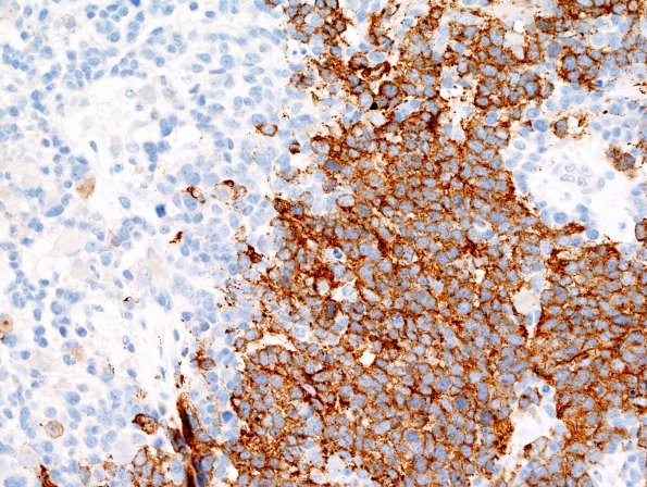 21C2 Gliosarcoma-PNET-Adenoid var (Case 21)  SYN 1