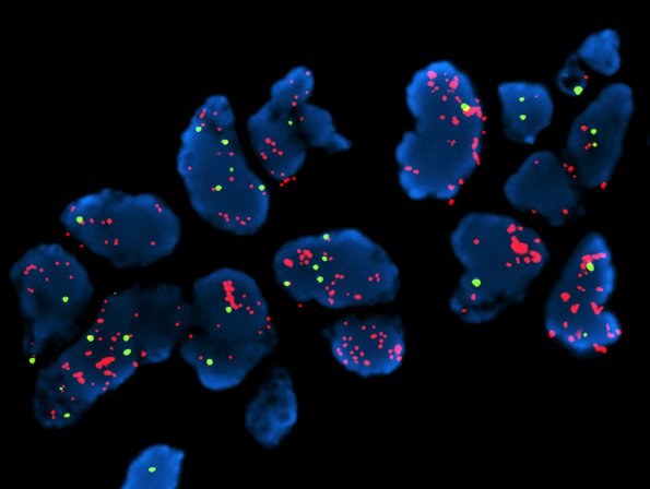 21C3 Gliosarcoma-PNET (Case 21) c-myc-AMP - Copy