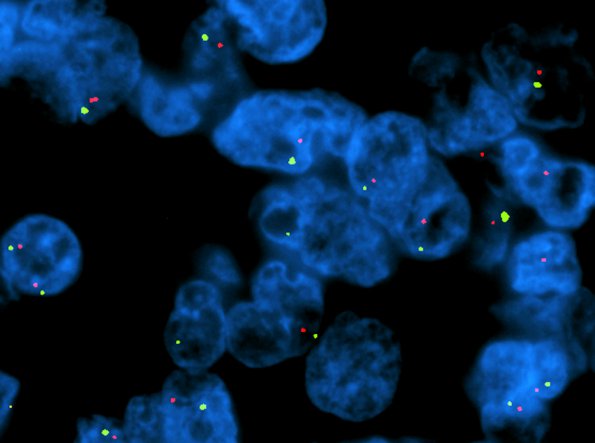 21C4 Gliosarcoma-PNET (Case 21) -10q