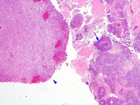 2A2 GBM, PNET (Case 2) Junction B 4X H&E copy.jpg