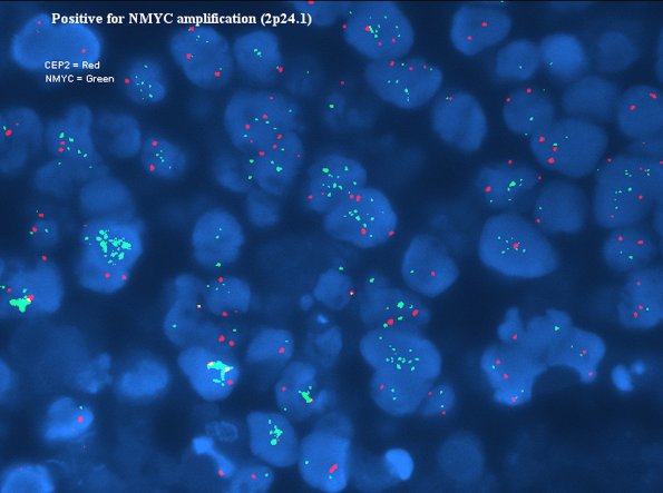 2F GBM, PNET (Case 2) FISH nmyc cep 2 100x - Copy