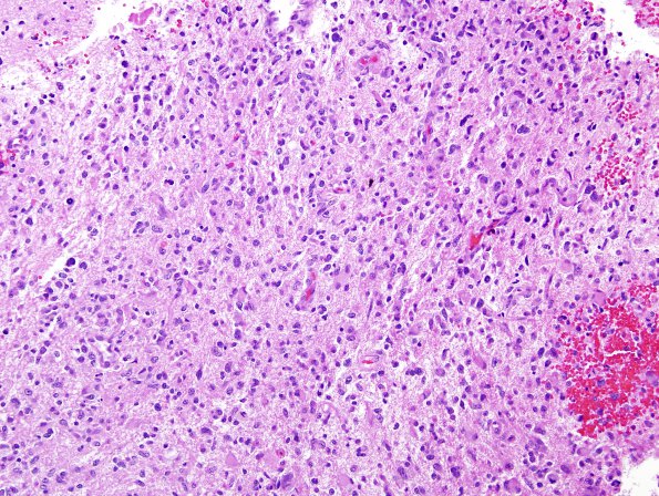 8A3 GBM w PNET features (Case 8) H&E 6