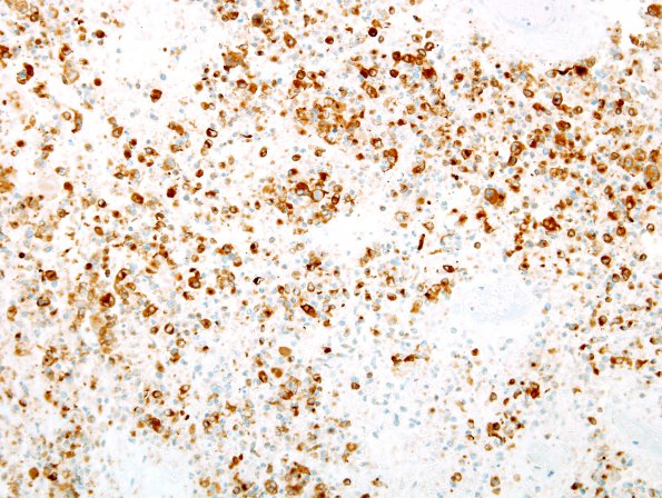 8C3 GBM w PNET features (Case 8) SYN 2