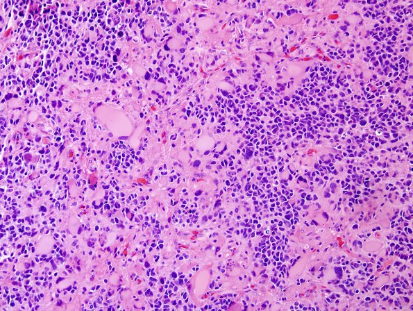 9A3 GBM, giant cell and PNET (Case 9) H&E 7.jpg