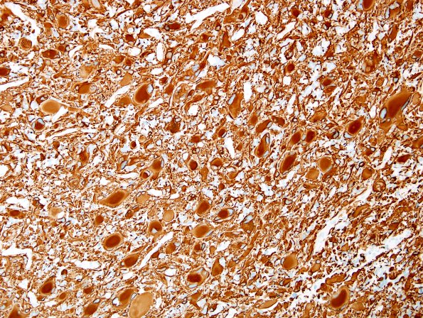 9B GBM, giant cell and PNET (Case 9) GFAP 1.jpg