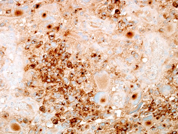 9C3 GBM, giant cell and PNET (Case 9) SYN 1.jpg