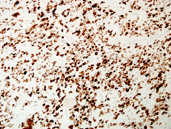 9D GBM, giant cell and PNET (Case 9) p53 5.jpg