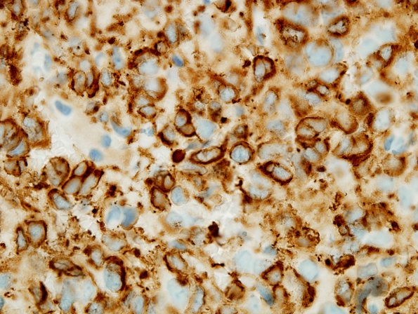 10B2 Oligodendroglioma (Case 10) 100X GFAP 2