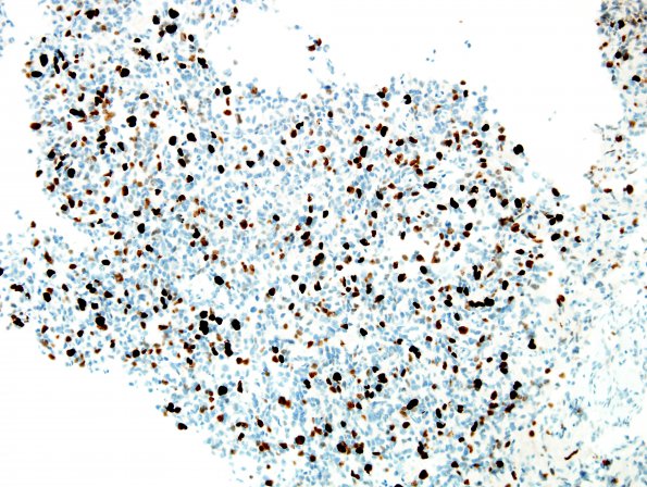 10C Oligodendroglioma (Case 10) GBM MIB